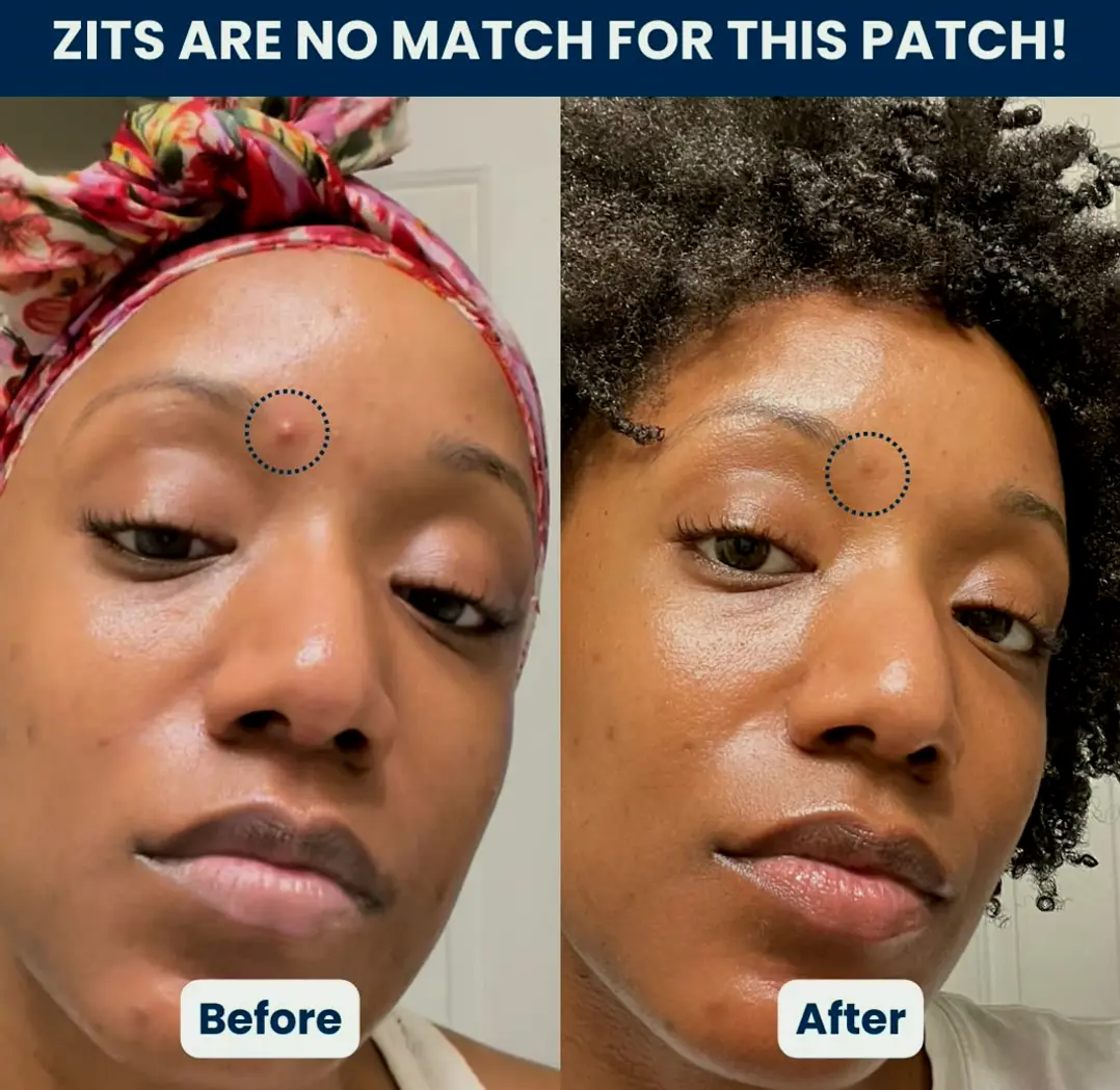 Vegan Pimple Patches - Zit Treatment Sticker